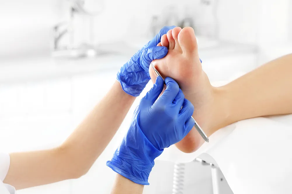 Corn and callus treatment